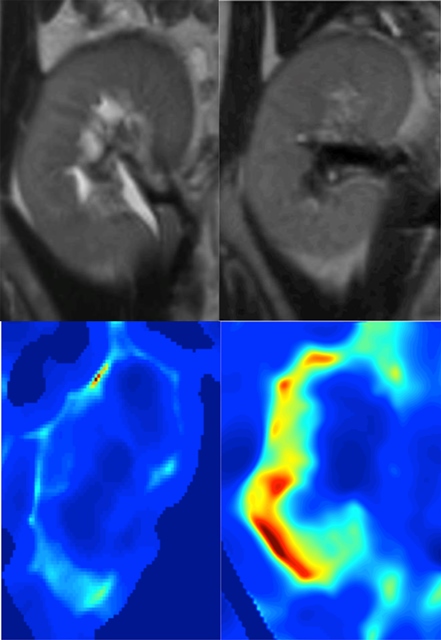 Using MRIs to predict kidney failure