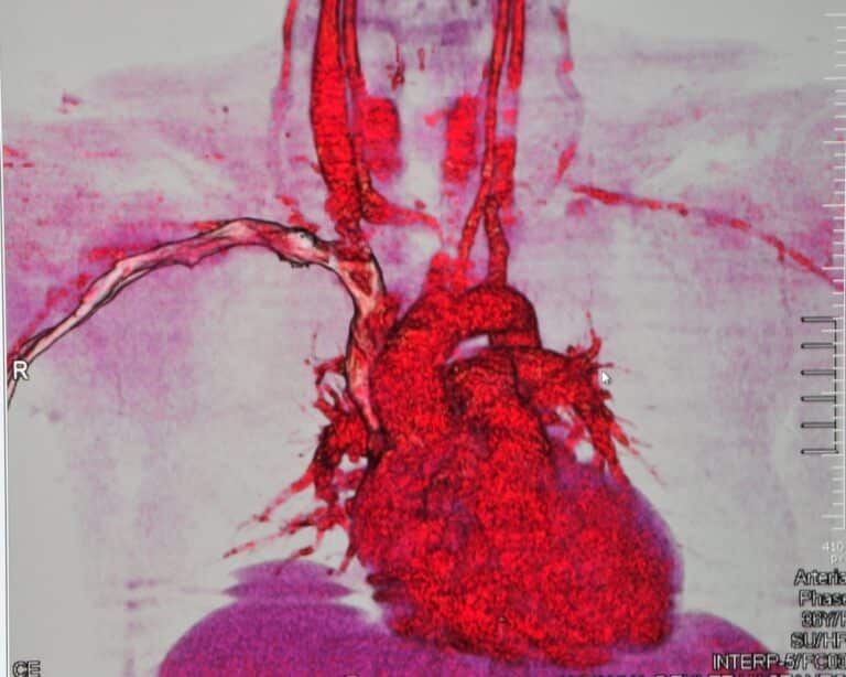 Younger men at highest risk of cardiovascular hospitalizations after COVID-19