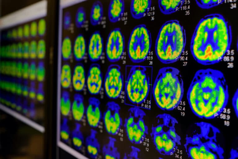 New study finds subgroups of kids with similar brain patterns do not share diagnostic labels
