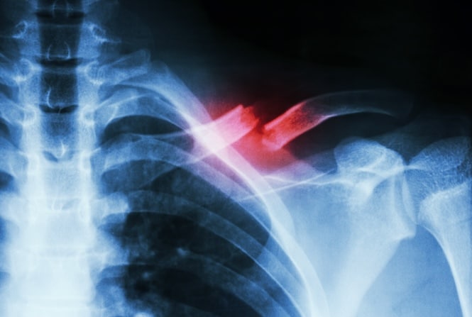 Comprehensive new Canadian guideline for skeletal health and fracture prevention
