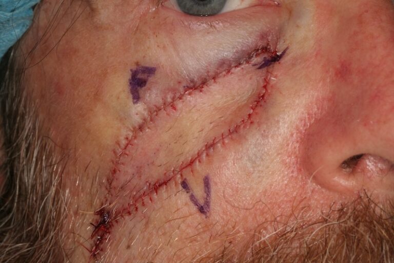 Facing the facts: Suture materials and scar prominence post-surgery