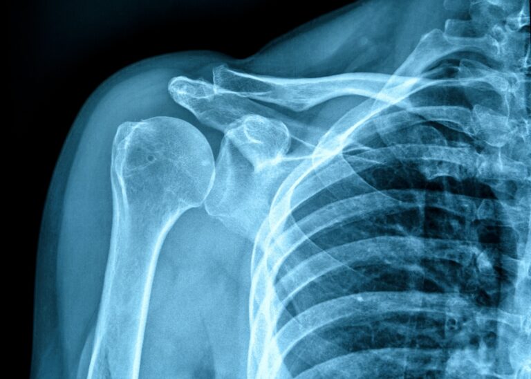 Discovery unravels the mystery of a rare bone disease