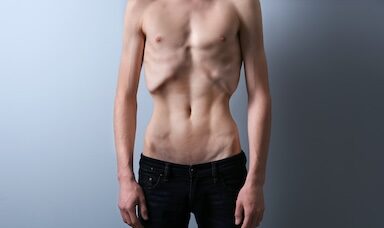 Anorexia nervosa can be life threatening in males