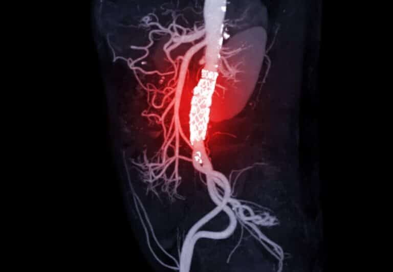 Surgical guidance with AI