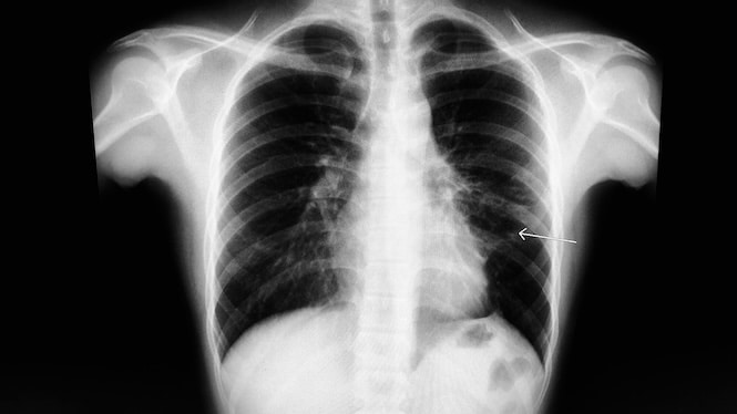 Fibrosis: Researchers outline how cells activate to cause fibrosis and organ scarring