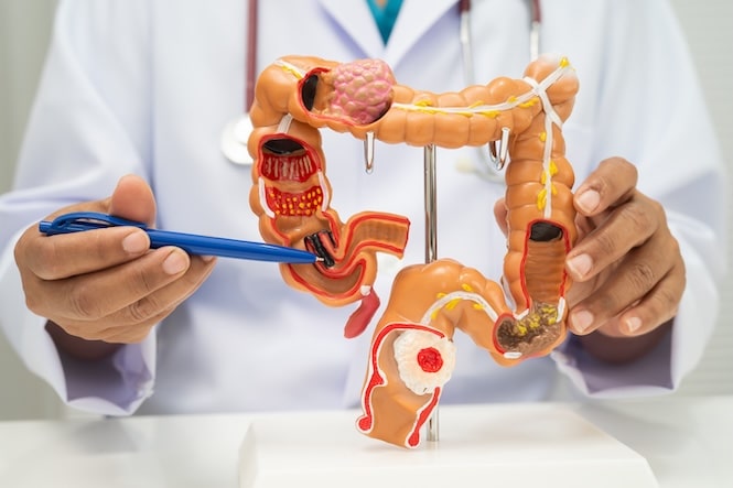 Canadian Cancer Society urges lowering colorectal cancer screening age to 45